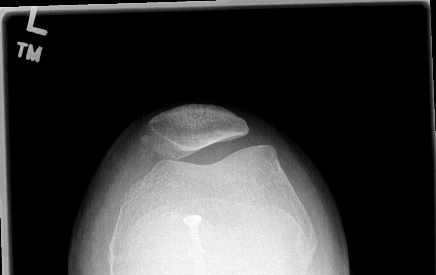 Chronic Patella Dislocation 5